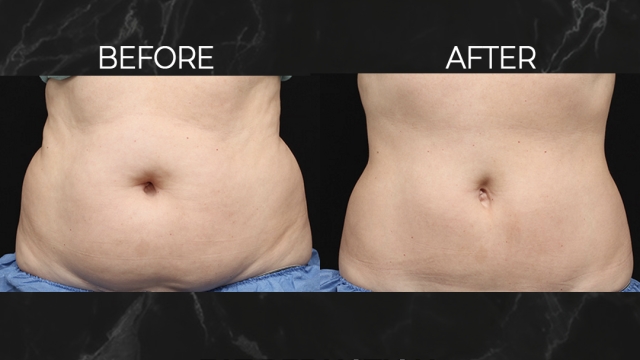 Frozen to Fabulous: Unleashing the Power of Cool Sculpting to Melt Away Stubborn Fat