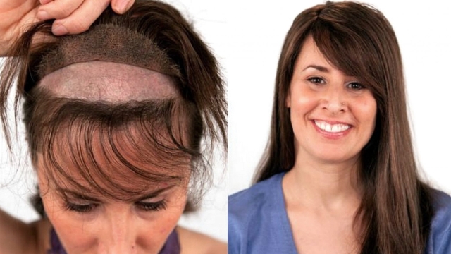 Bridging the Gap: Transformative Hair Implants for a New You